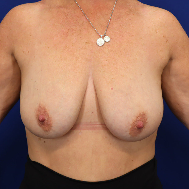 Breast Augmentation Mastopexy Before & After Image