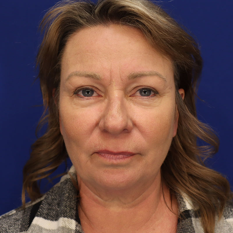 Facelift Before & After Image