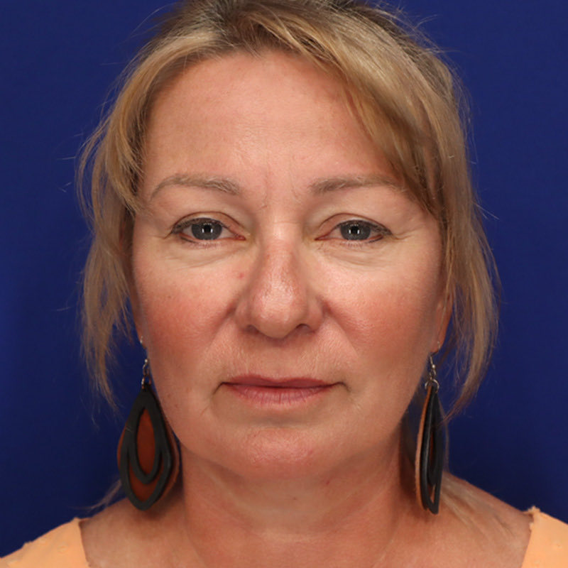 Facelift Before & After Image