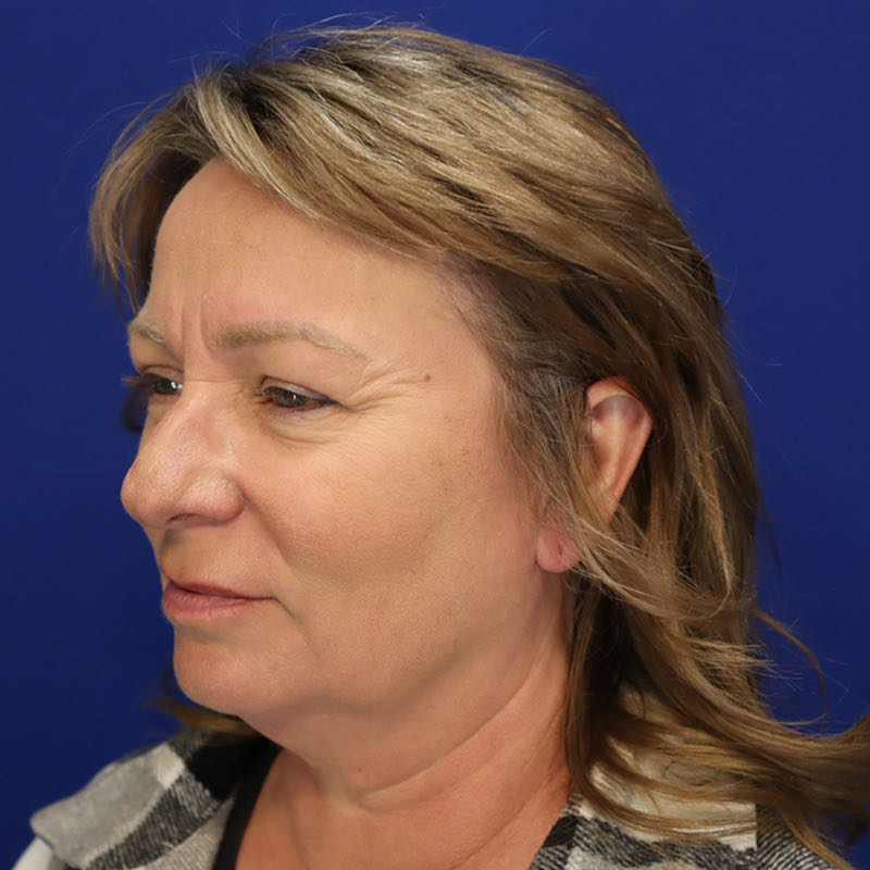 Facelift Before & After Image