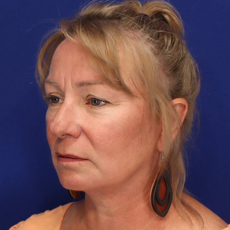 Facelift Before & After Image