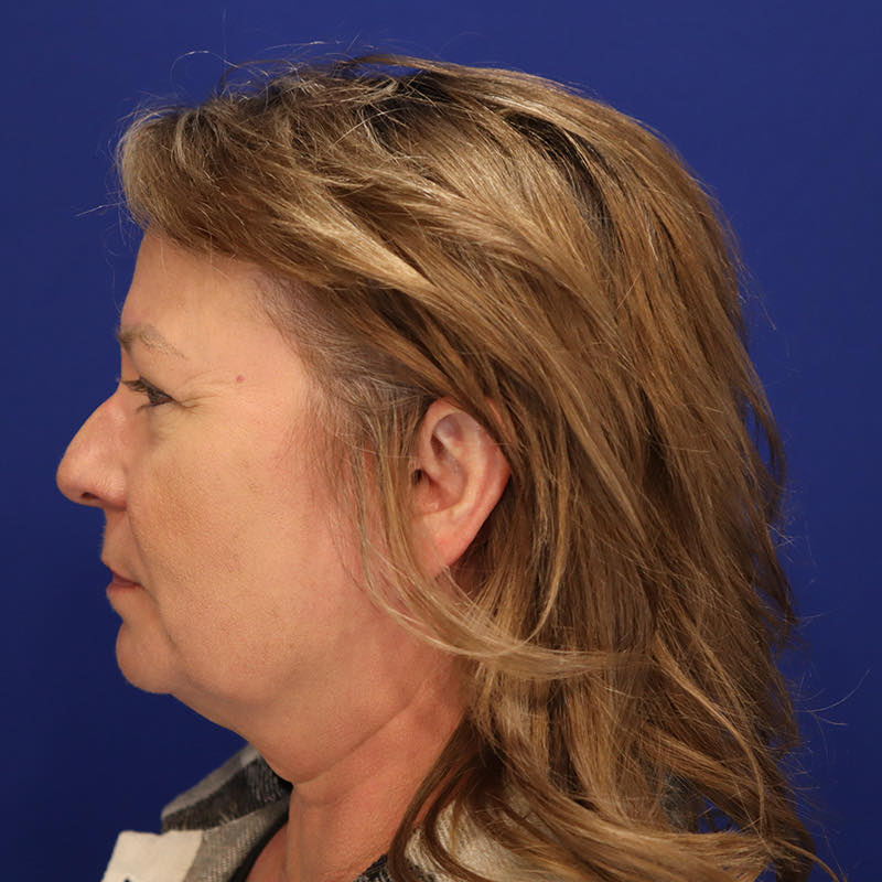 Facelift Before & After Image