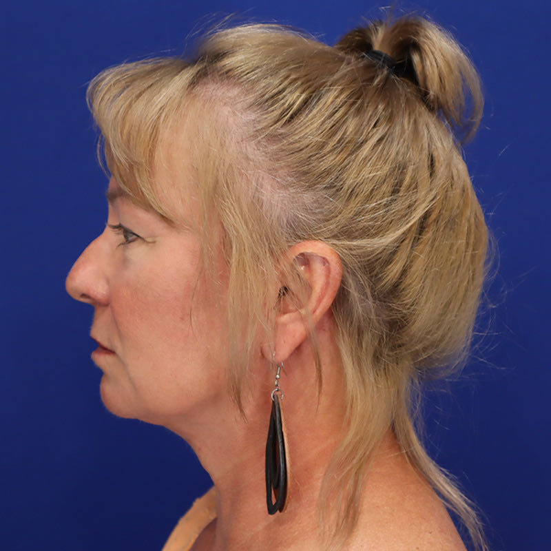 Facelift Before & After Image