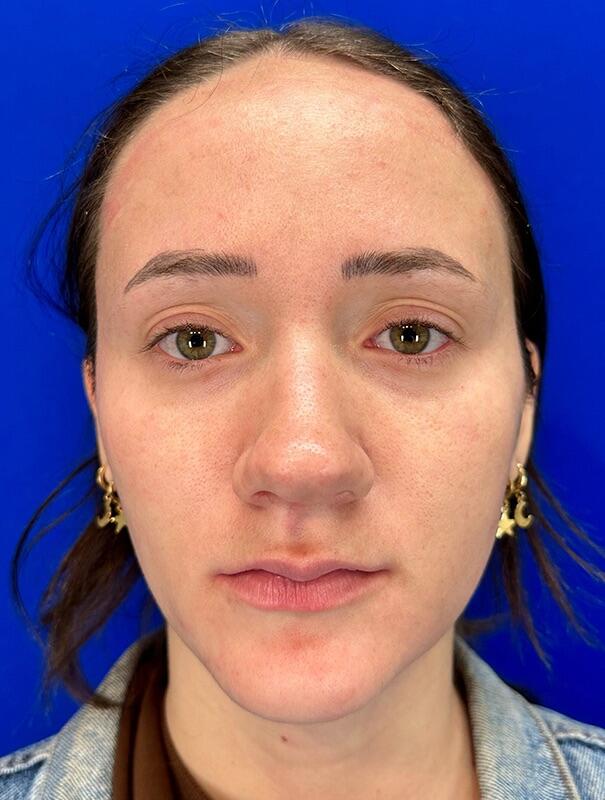 Rhinoplasty Before & After Image