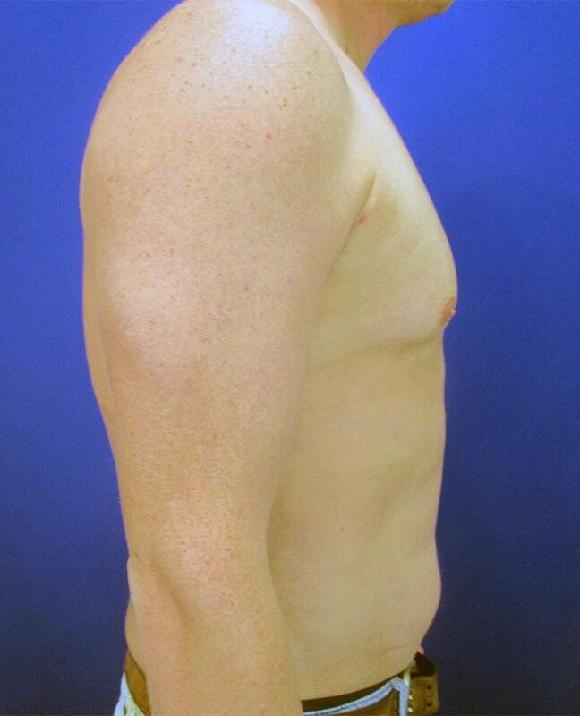 Gynecomastia Before & After Image